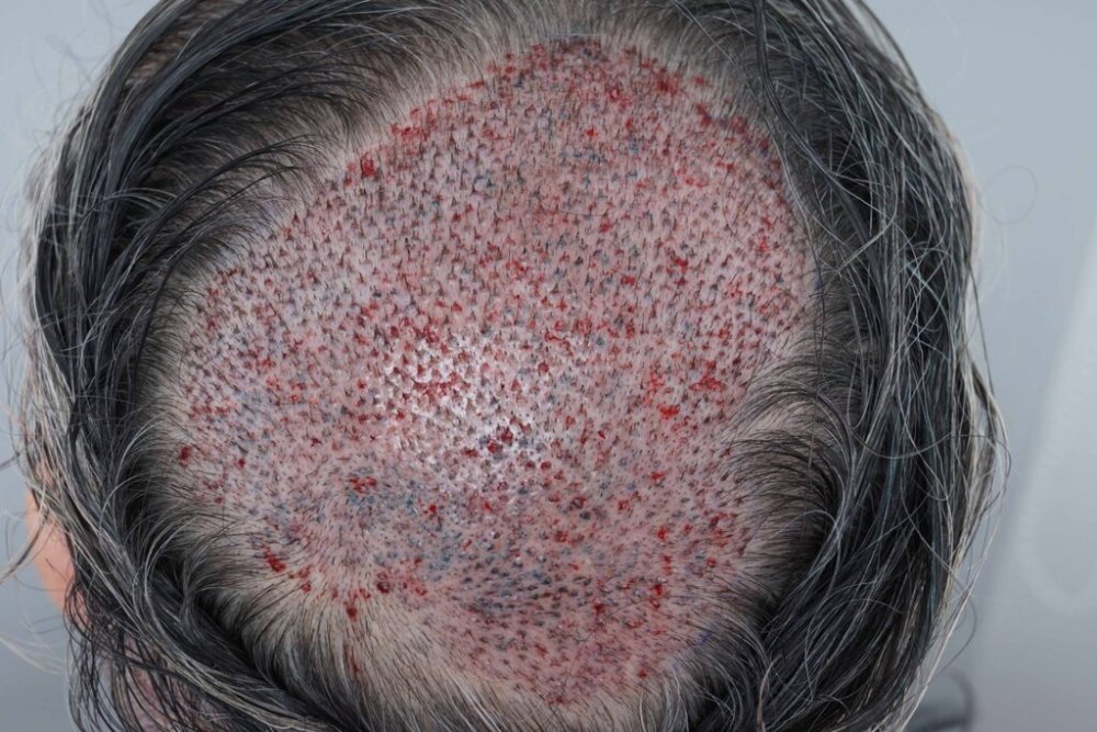 Farjo hair transplant3.jpg