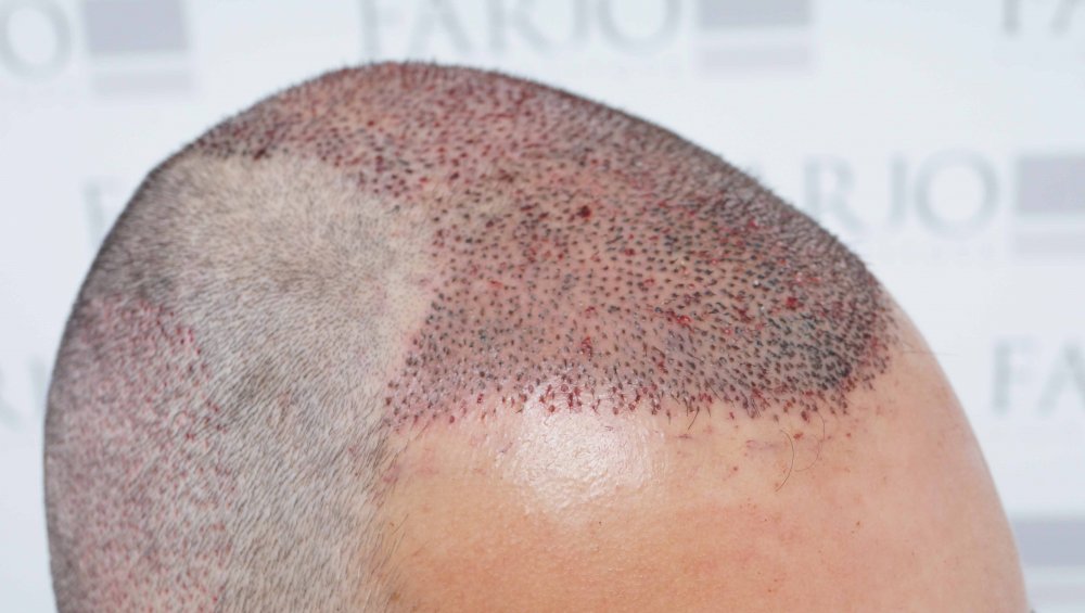 Farjo hair transplant4.jpg