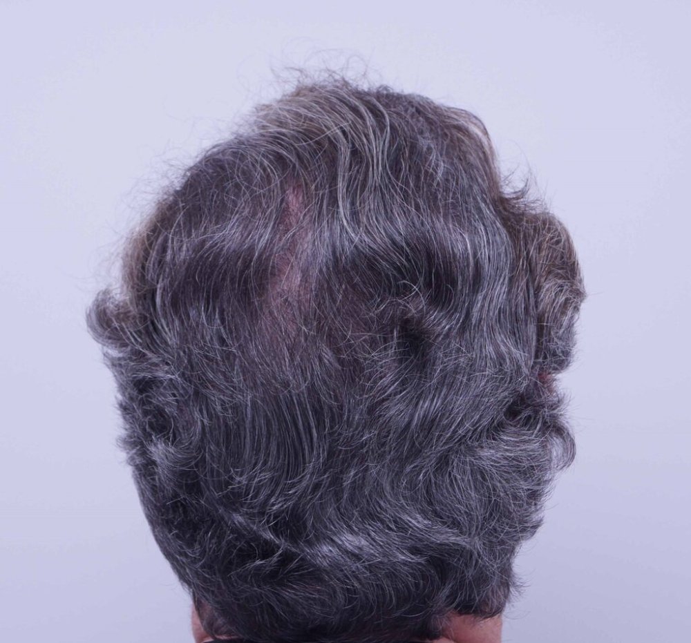 Farjo hair transplant4.jpg