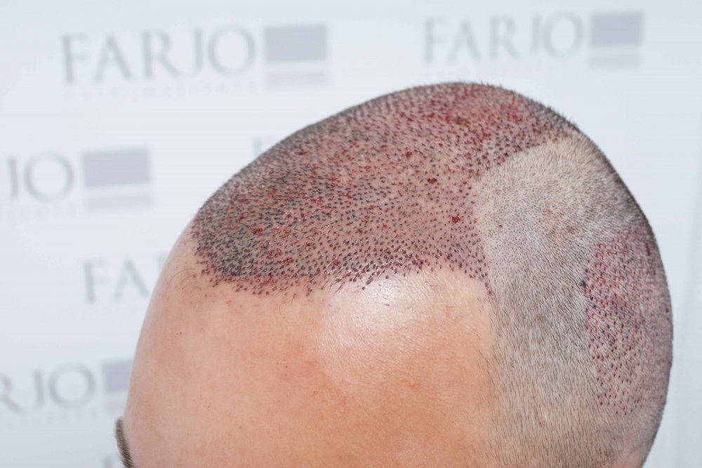 Farjo hair transplant5.jpg