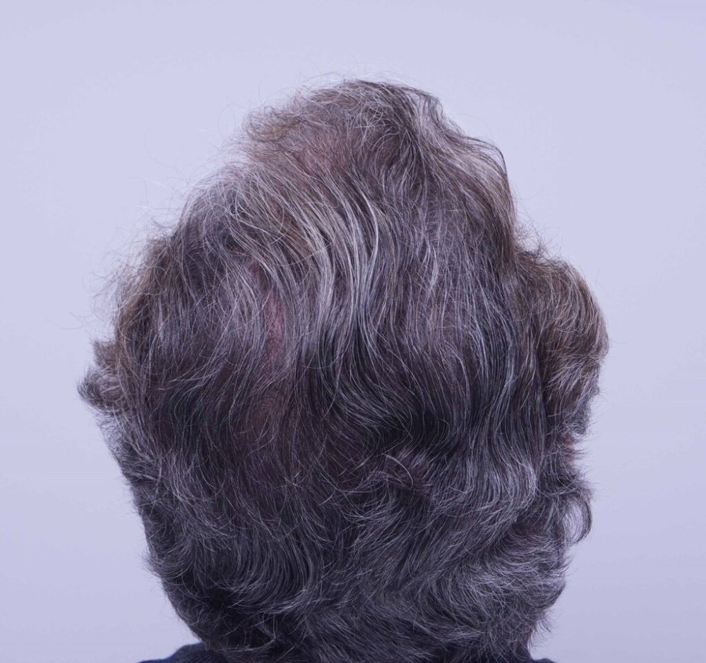 Farjo hair transplant5.jpg