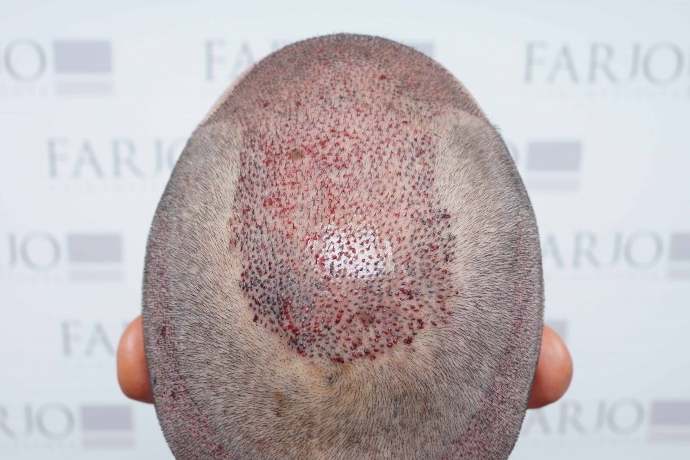 Farjo hair transplant6.jpg