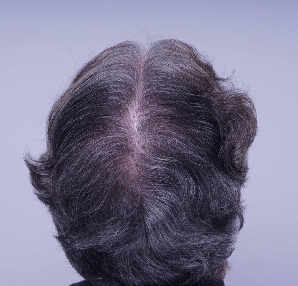 Farjo hair transplant6.jpg