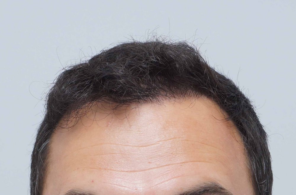 Farjo hair transplant7.jpg