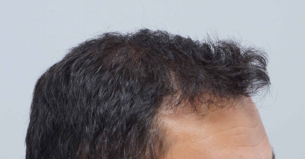 Farjo hair transplant8.jpg