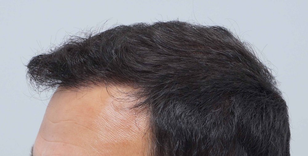 Farjo hair transplant9.jpg