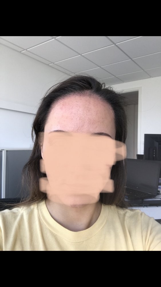 Female hairline hair transplant - Dr. Feriduni10.jpeg
