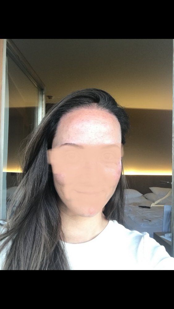 Female hairline hair transplant - Dr. Feriduni12.jpeg