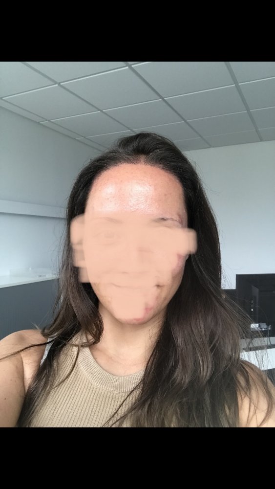 Female hairline hair transplant - Dr. Feriduni14.jpeg