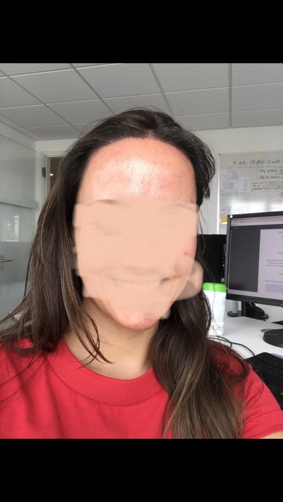 Female hairline hair transplant - Dr. Feriduni16.jpeg