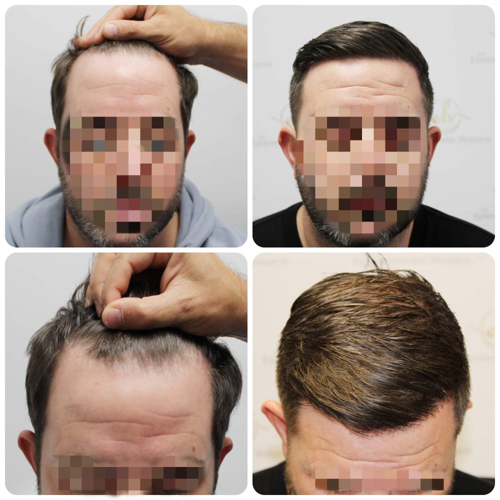 final-result-hair-transplant-dr-bonaros-glasgow.jpg