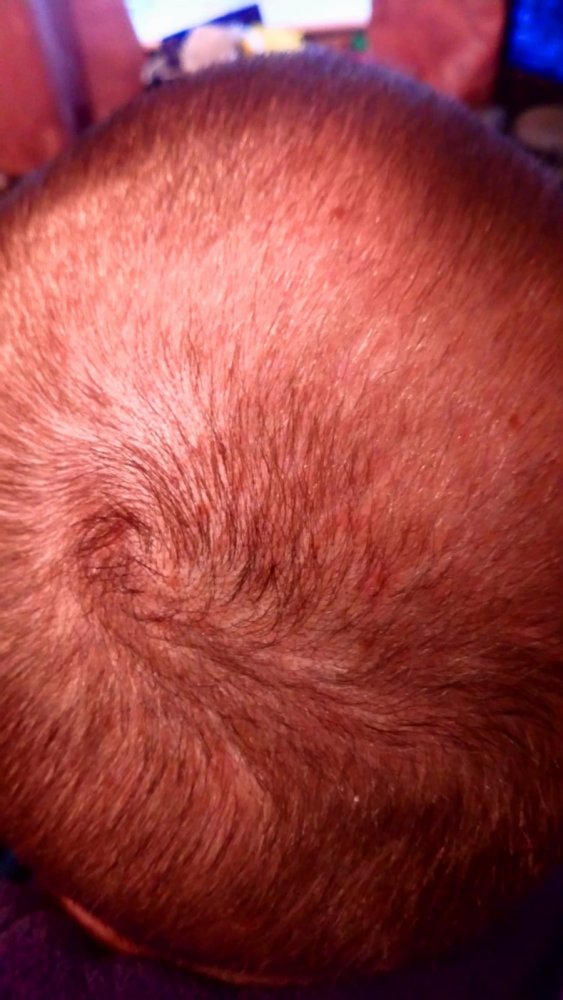 Finasteride 6 month close up.jpg