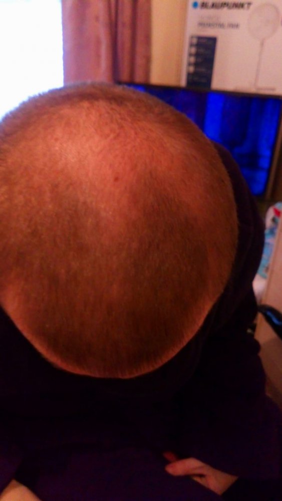 Finasteride 6 month progress.jpg
