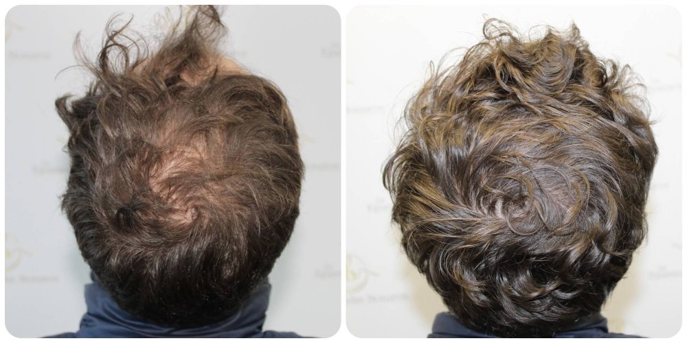 finasteride-crown-growth.jpg