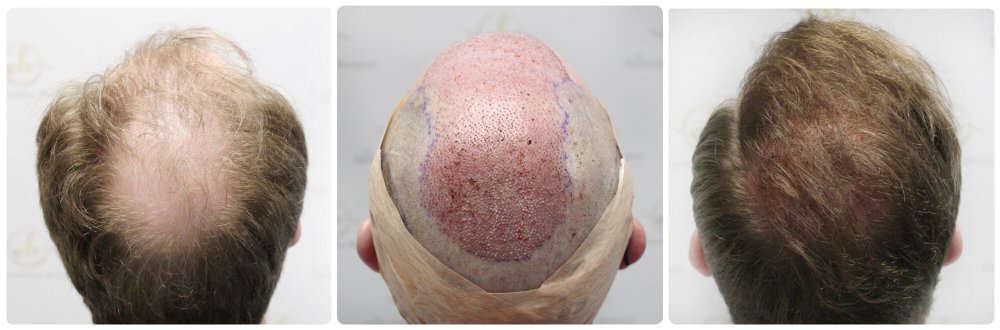 forum-result-hair-transplant-dr-bonaros (1) (1).jpg