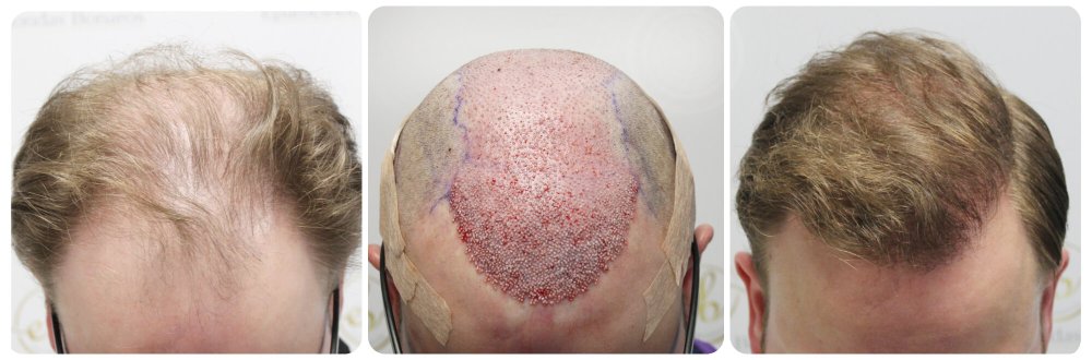 forum-result-hair-transplant-dr-bonaros (2).jpg