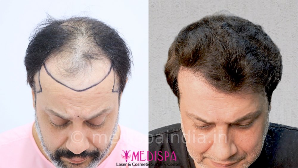 front comparison without watermark (1).jpg