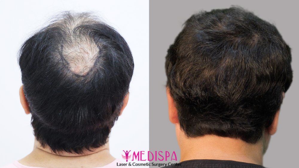 front comparison without watermark (4).jpg
