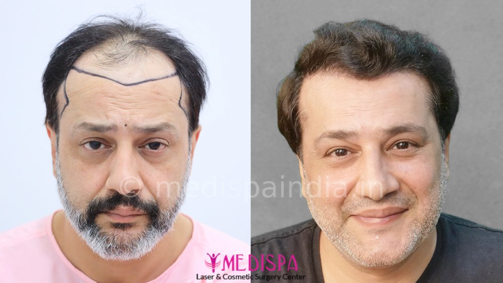 front comparison without watermark.jpg