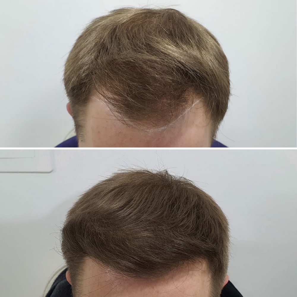 Front hairline 2.JPG