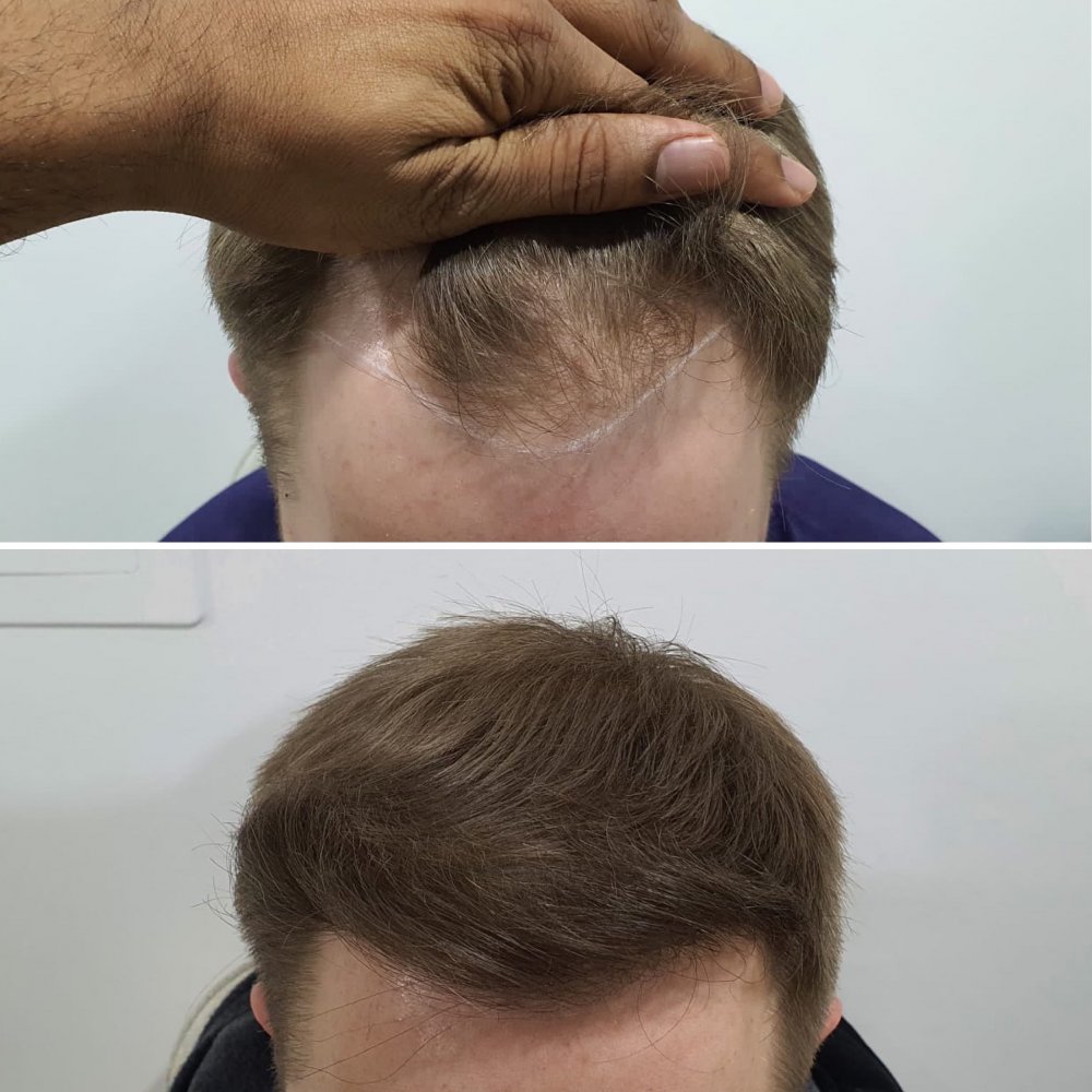 Front hairline.JPG
