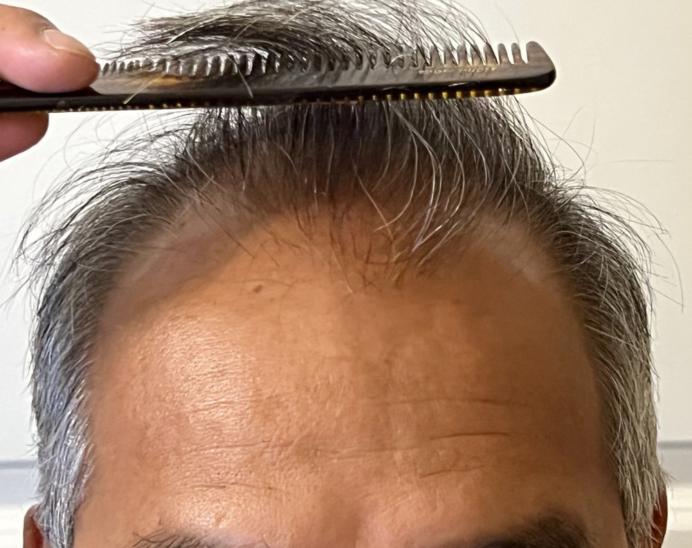 Front Hairline.jpg