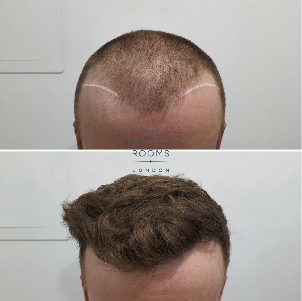 Frontal hairline 2.jpg