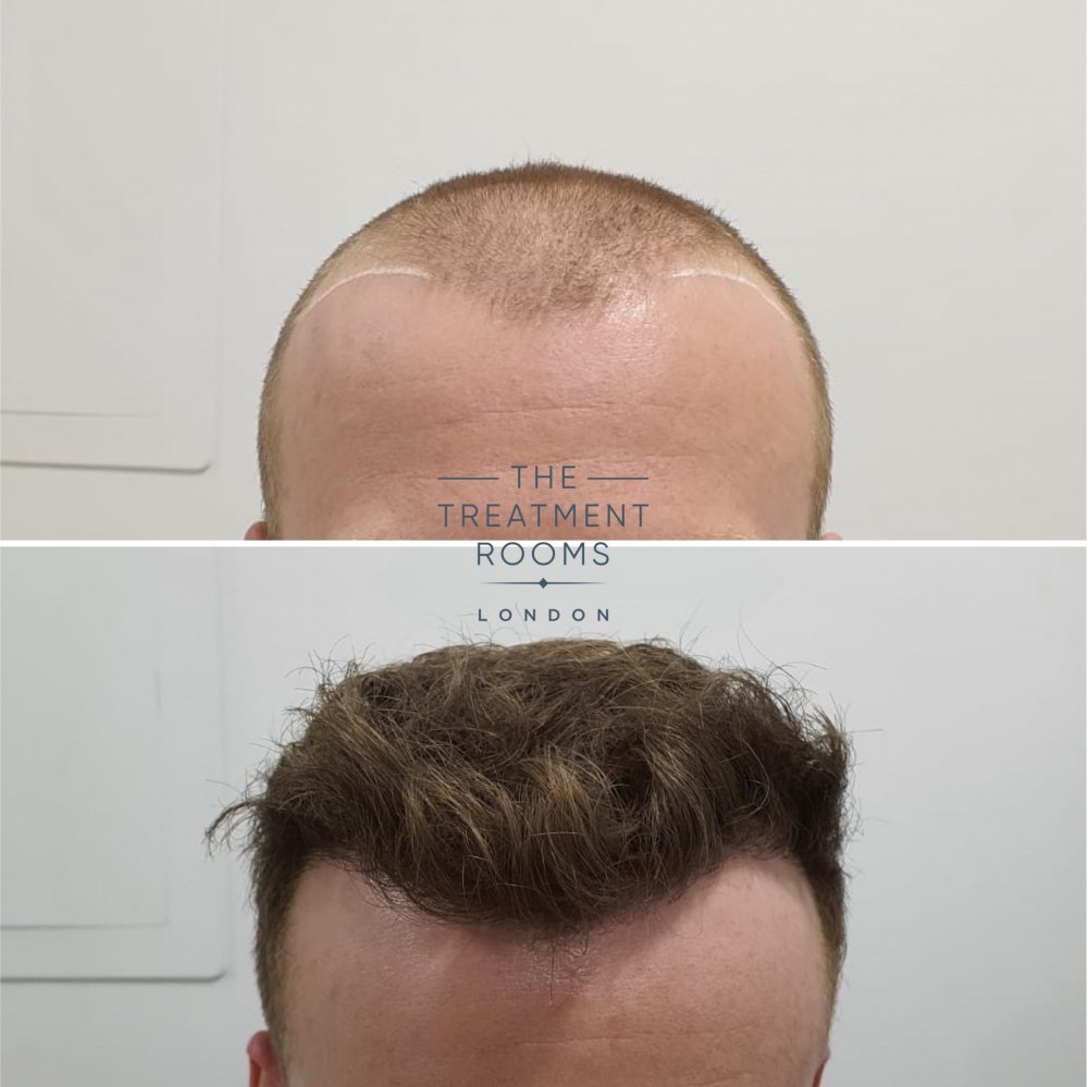 Frontal hairline 4.jpg