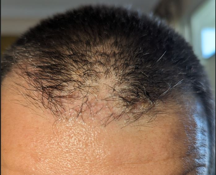 frontal_2w after 2nd repair.JPG