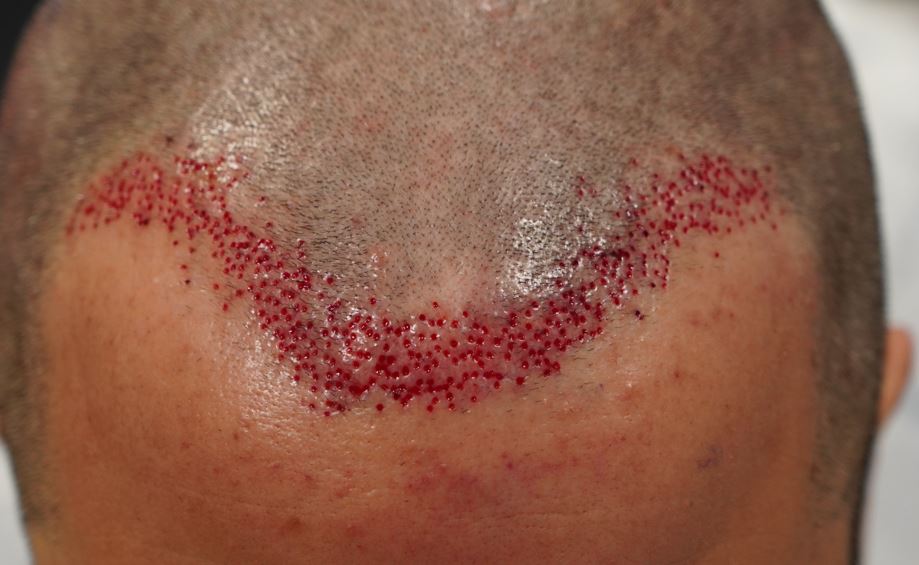 frontal_postsurgery.JPG