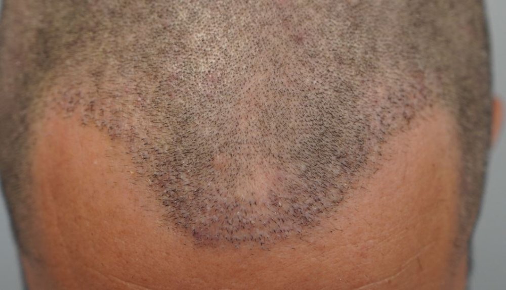 frontal_presurgery.JPG