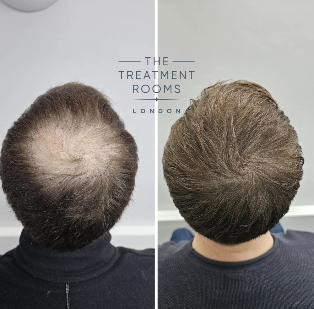 FUE-Crown-Hair-Transplant-Before-and-After-1380-grafts.jpeg