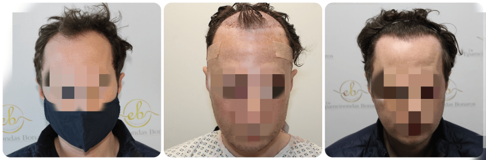 fue-dr-bonaros-hair-transplant-uk.png