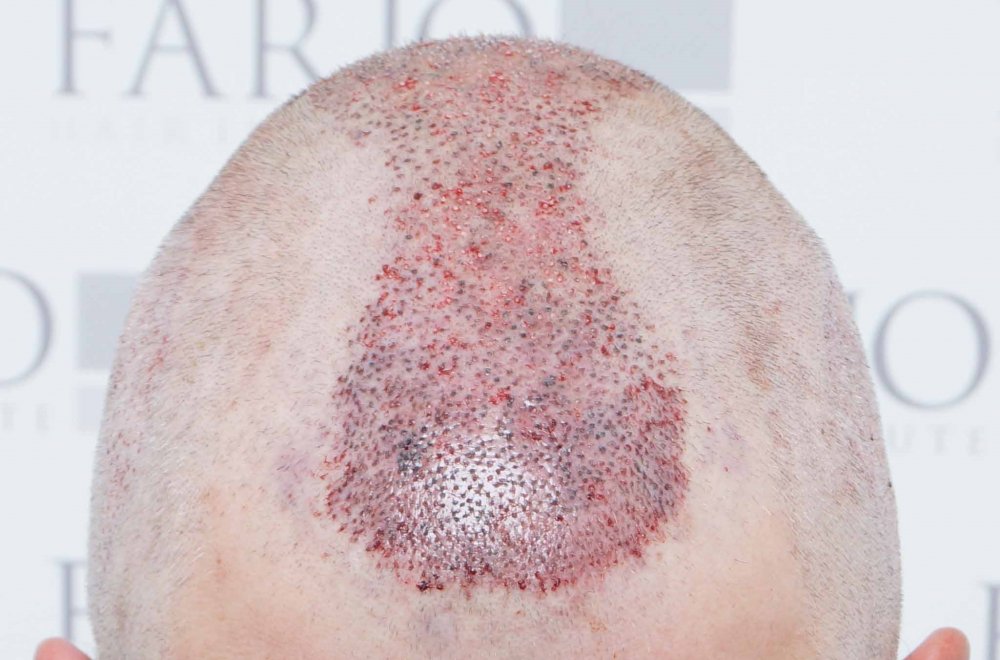 FUE Farjo Hair Institute12.jpg