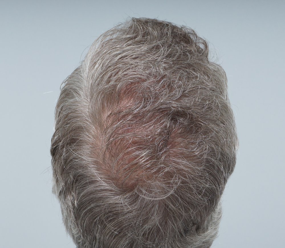 FUE Farjo Hair Institute5.JPG