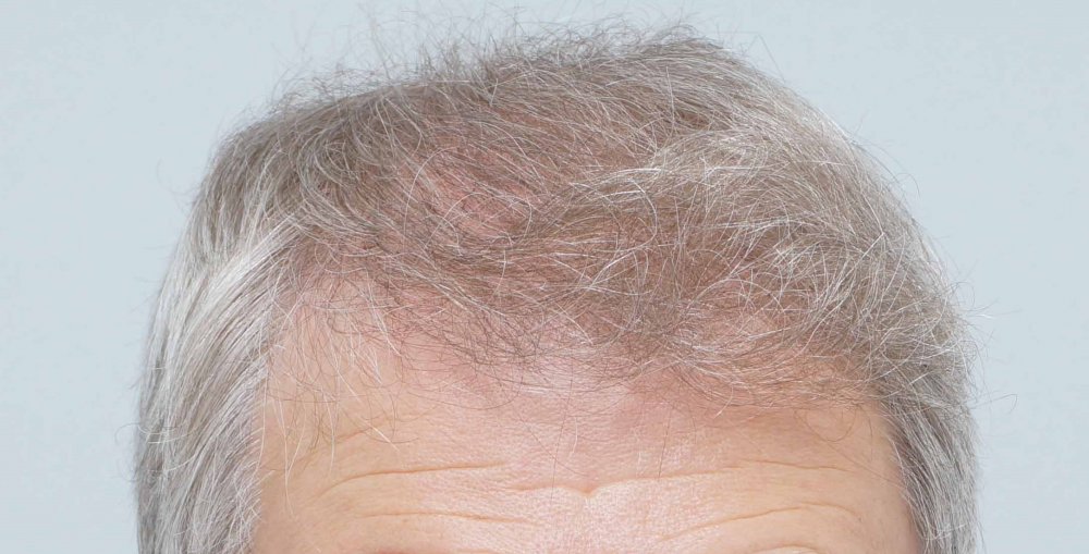 FUE Farjo Hair Institute6.jpg