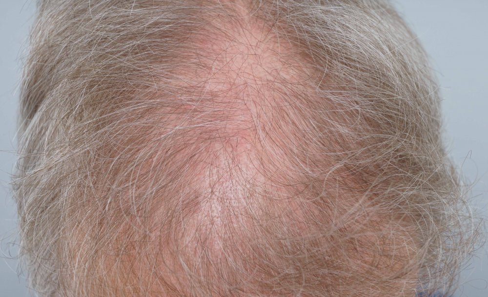 FUE Farjo Hair Institute8.jpg