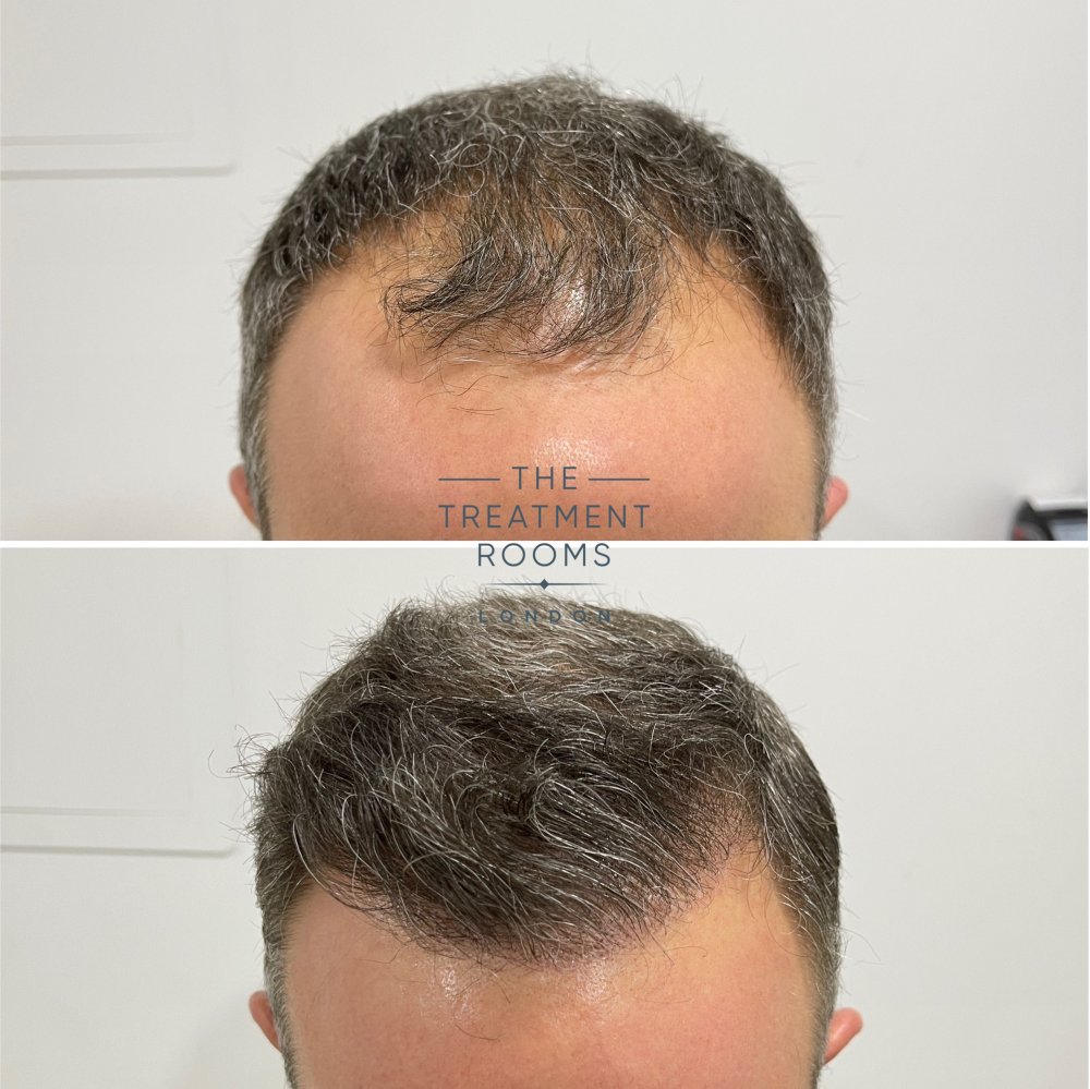 fue hair transplant 1788 grafts before and after.jpg