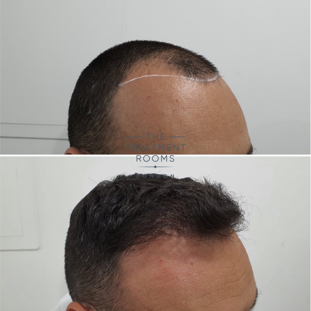 FUE hair transplant before and after 1498 grafts.jpg