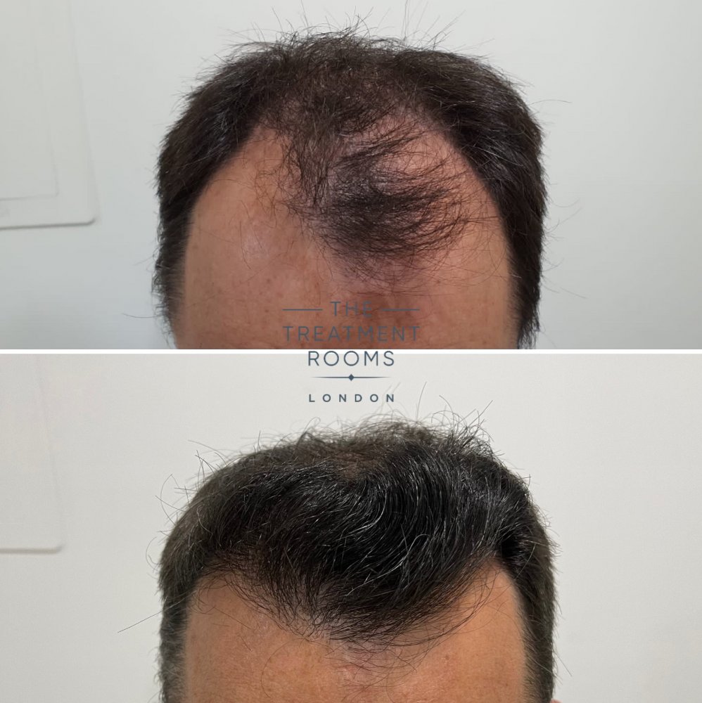 FUE hair transplant before and after.jpg
