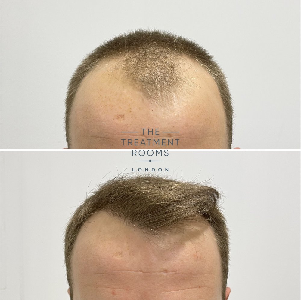 fue hair transplant clinic london 1756 grafts before and after.jpg