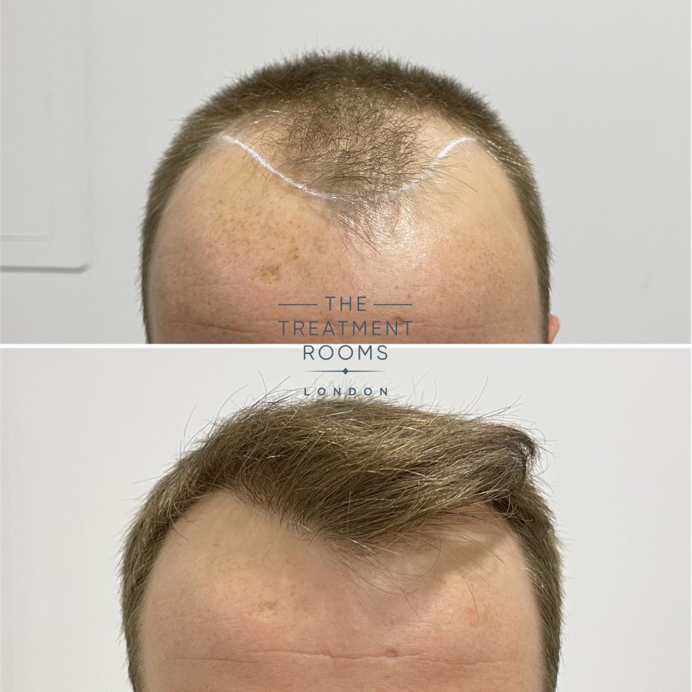 fue hair transplant clinic london 1756 grafts result.jpg