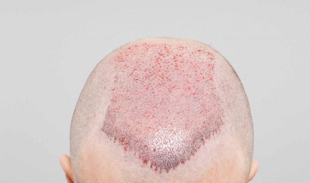 FUE Hair Transplant - Farjo Hair Institute1.jpg