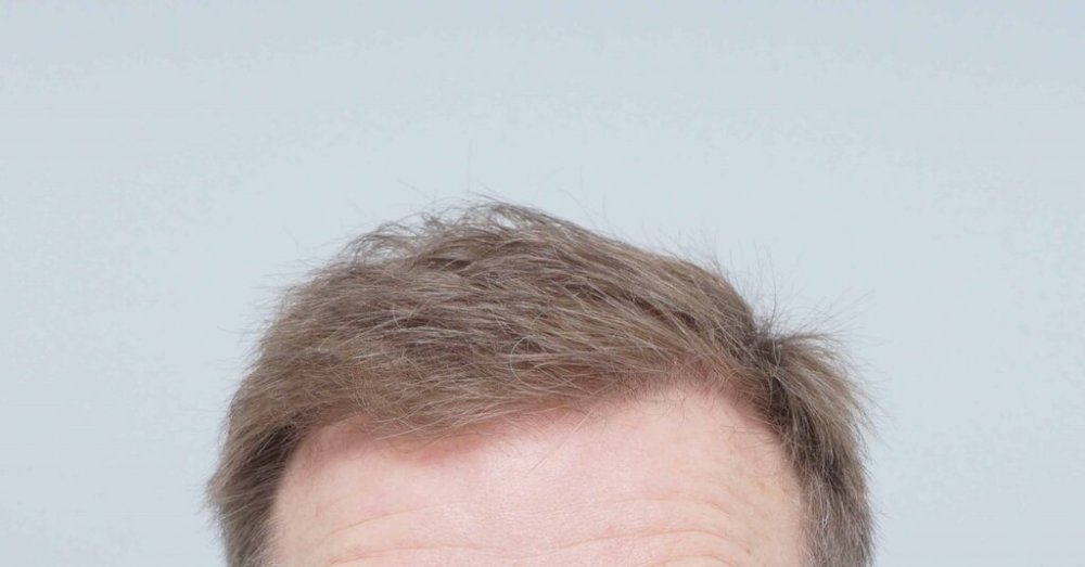 FUE Hair Transplant - Farjo Hair Institute10.jpg