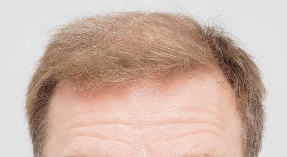 FUE Hair Transplant - Farjo Hair Institute11.jpg