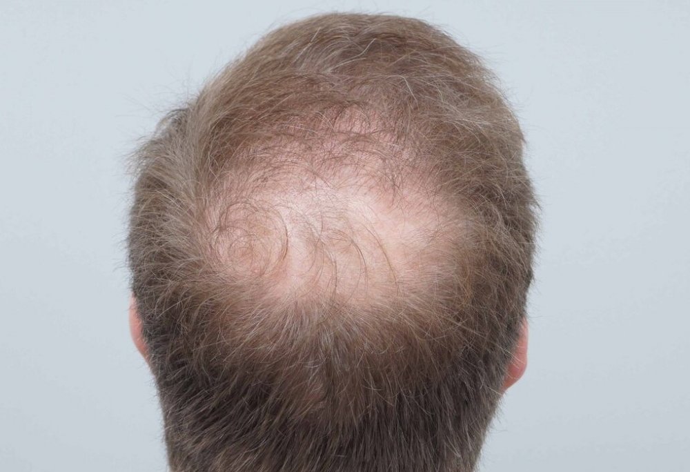 FUE Hair Transplant - Farjo Hair Institute2.jpg