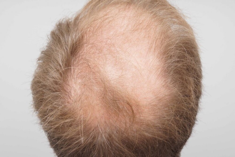 FUE Hair Transplant - Farjo Hair Institute3.jpg