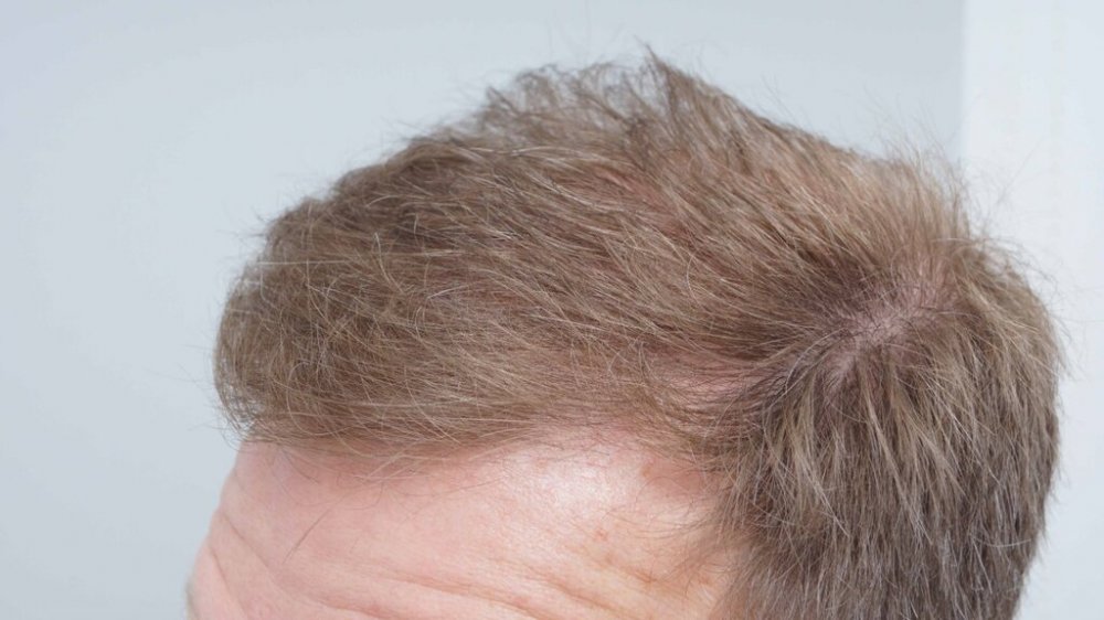 FUE Hair Transplant - Farjo Hair Institute4.jpg