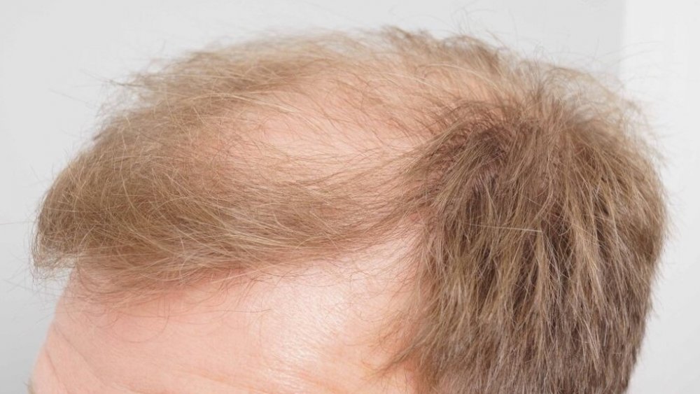 FUE Hair Transplant - Farjo Hair Institute5.jpg