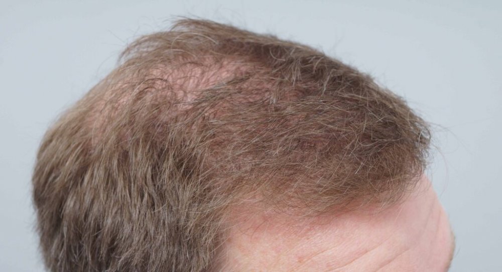 FUE Hair Transplant - Farjo Hair Institute6.jpg